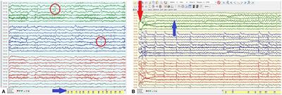 Case Report: Multisystem Autoimmune and Overlapping GAD65-Antibody-Associated Neurological Disorders With Beneficial Effect of Epilepsy Surgery and Rituximab Treatment